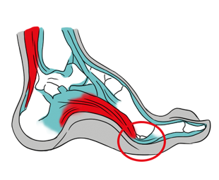 Imagem ilustrativa sobre Pé cavo e área de sobrecarga sobre os ossos sesamoides 