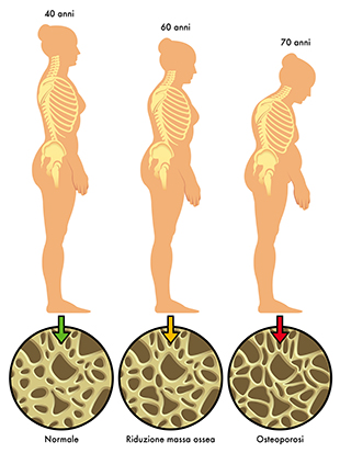 1. Evolução da osteoporose e rarefação óssea
