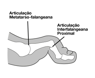 metatarsalgia 3