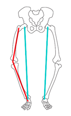 Ilustração mostrando como ficam posicionados os membros inferiores de uma pessoa com joelho varo.