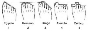 dedo de morton tipos de pes