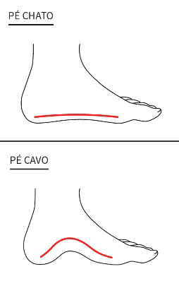 Imagem ilustrativa de um pé cavo e um pé chato.