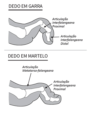 treinamento diabetes controlada