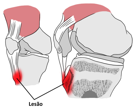 Imagem ilustrativa representando a lesão na cartilagem do joelho causada pela osteocondrite.
