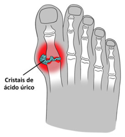 Imagem ilustrativa mostrando a formação de cristais de ácido úrico na articulação do dedão.