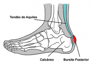 Bursite retrocalcanea