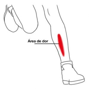 Imagem ilustrativa indicando a região das dores da canelite.