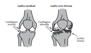 Imagem ilustrativa mostrando a diferença entre um joelho saudável e outro com artrose.