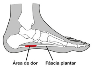 Imagem da estrutura óssea de um pé com a região atingida pela fascite plantar destacada em vermelho.