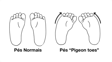 4. Pé normal e pé de pombo