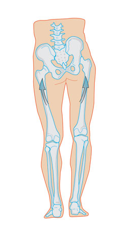 Imagem ilustrativa de um corpo humano com a diferença de membros nas pernas