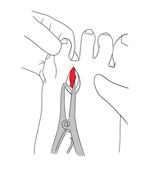 Imagem ilustrativa mostrando como é feita a cirurgia de retirada do neuroma de Morton