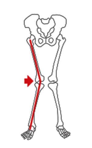 2.  Joelho para dentro (valgo) 