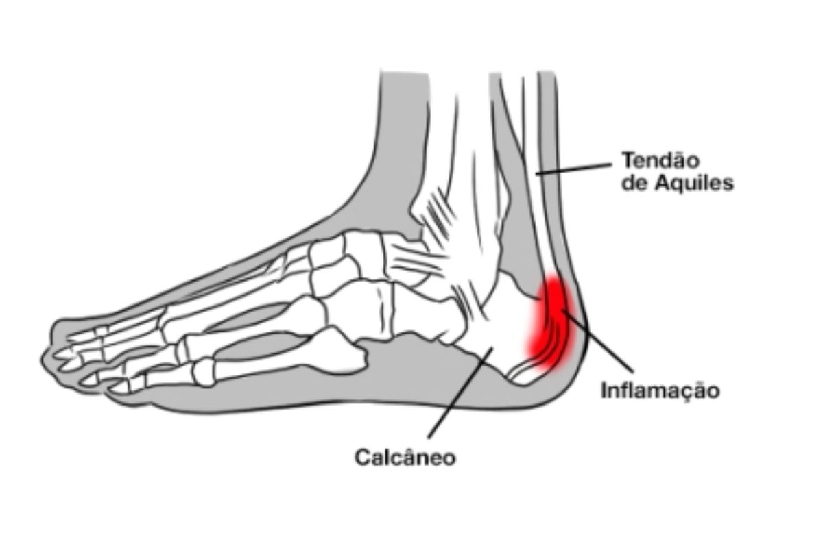 Os perigos da Tendinite de Calcâneo Instituto Trata