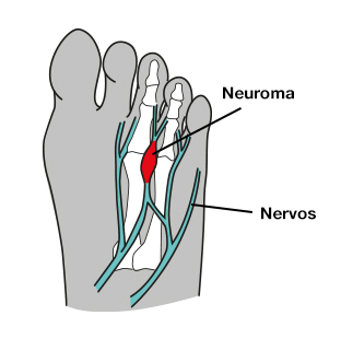 dor todos metatarsos pé neuroma morton