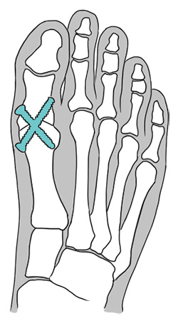 Ilustração de como é feita a cirurgia de artrodese.