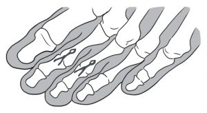 cirurgia dedo martelo garra