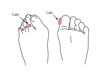 Porque aparecem calos?