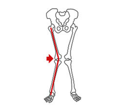 osteoporose joelho valgo