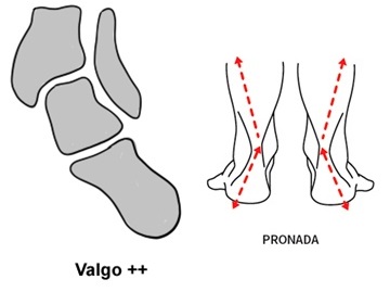 Alinhamento em valgo e pisada pronada.