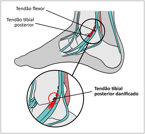 Tendinite do tibial posterior