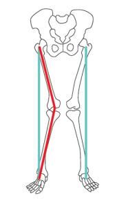 Ilustração de um um joelho valgo
