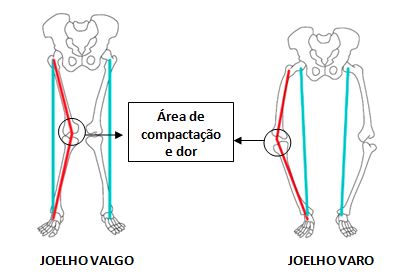 Imagem ilustrativa sobre joelho valgo.