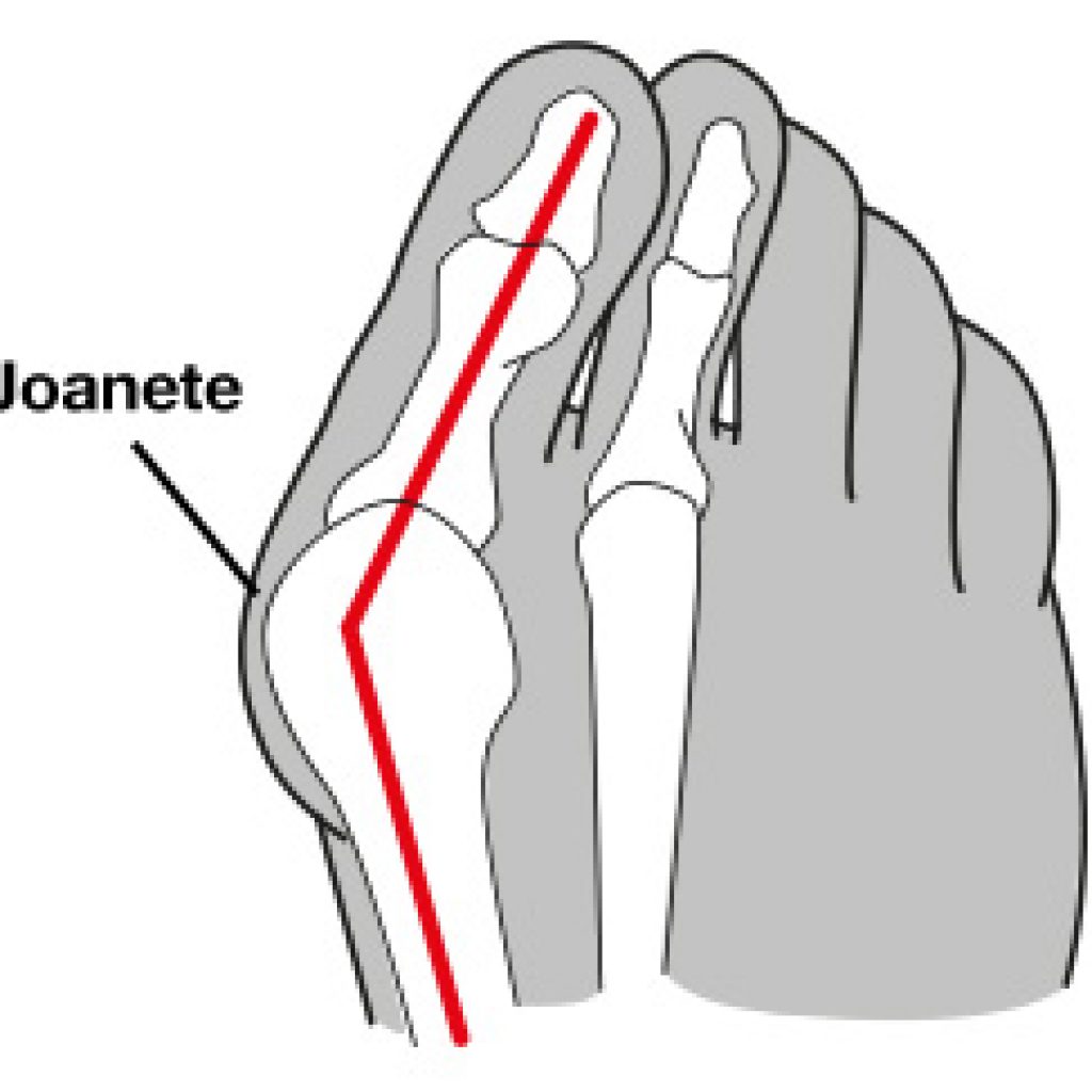 Joanete pode causar dor no dedão