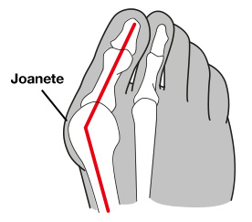 Imagem ilustrativa da região acometida pela joanete.