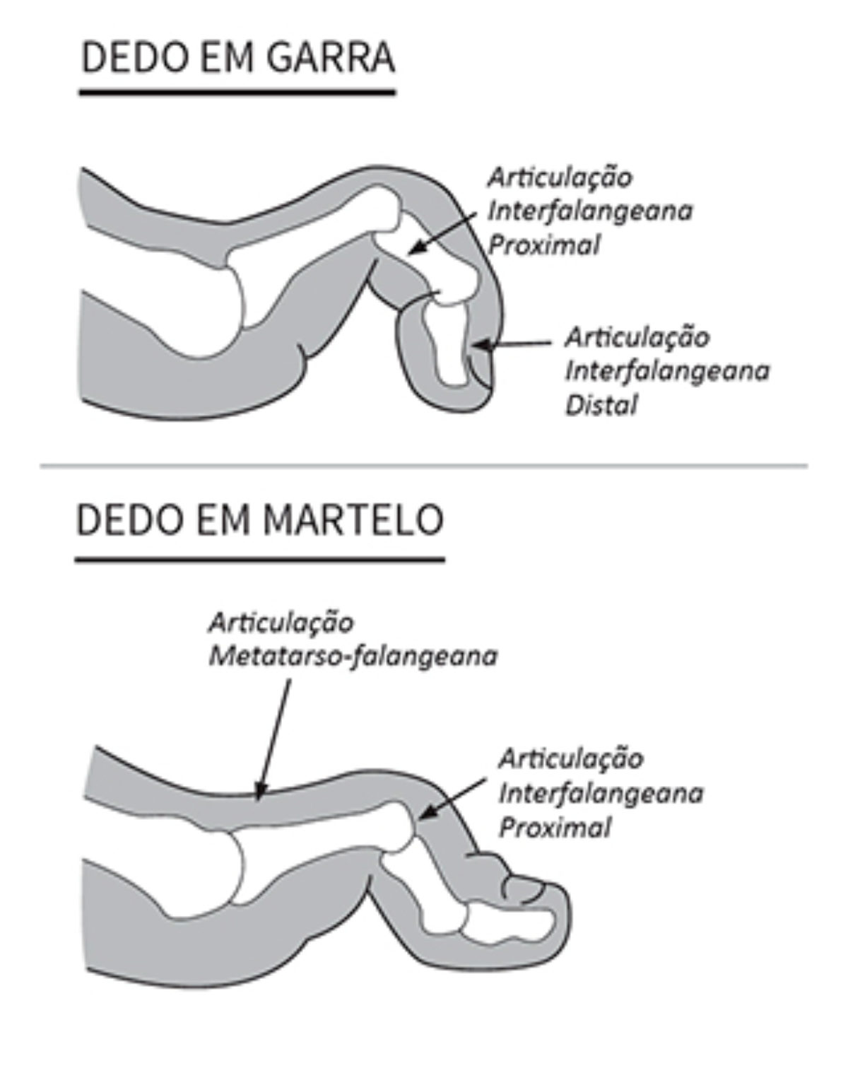 einfallen alaska konsistent síndrome do dedo do pé em martelo