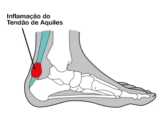Inflamação do tendão de Aquiles