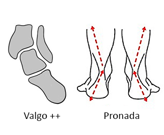 Tornozelo valgo e pisada pronada