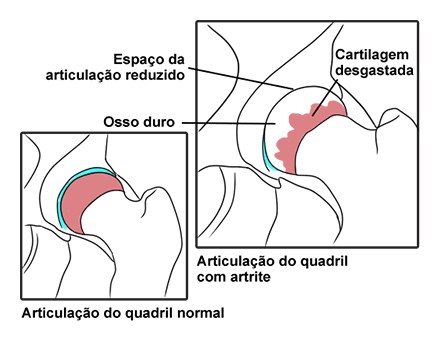 Ilustração explicativa sobre articulação com artrite e sem 