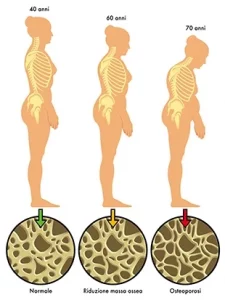 Diminuição da estatura provocada pela osteoporose.