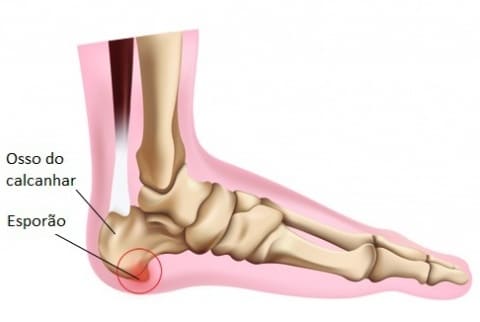Região da dor na palma do pé causada pelo esporão