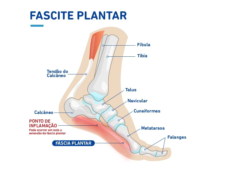 Região da dor na plama do pé causada pela fascite