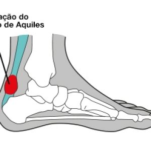 Imagem ilustrativa da localização do tendão de Aquiles no tornozelo