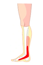 newhome_dores_canela-medial Ilustração de perna com a parte interna da canela destacada em vermelho, indicando dor no tibial posterior