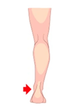 newhome_dores_tornozelo-medial Ilustração de perna em vista posterior com seta vermelha indicando dor na lateral interna do tornozelo