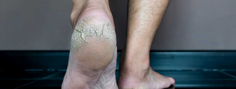 Rachadura nos pés: tratamento e prevenção | Pés Sem Dor